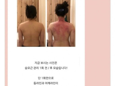승모근 관리 전,후