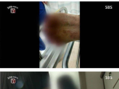 궁금한 이야기Y 발가락이 전부 사라진 사건 ..JPG