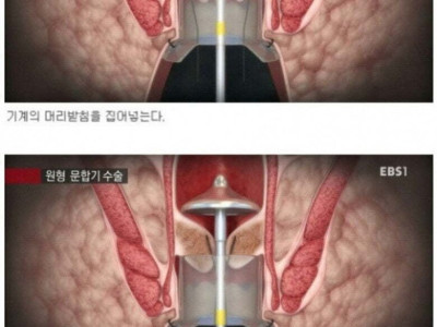 치질 수술 기계
